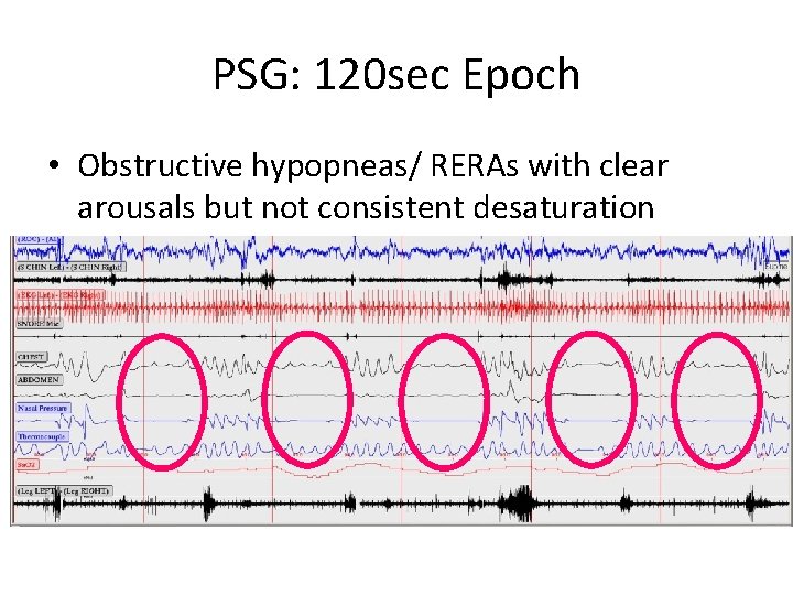 PSG: 120 sec Epoch • Obstructive hypopneas/ RERAs with clear arousals but not consistent