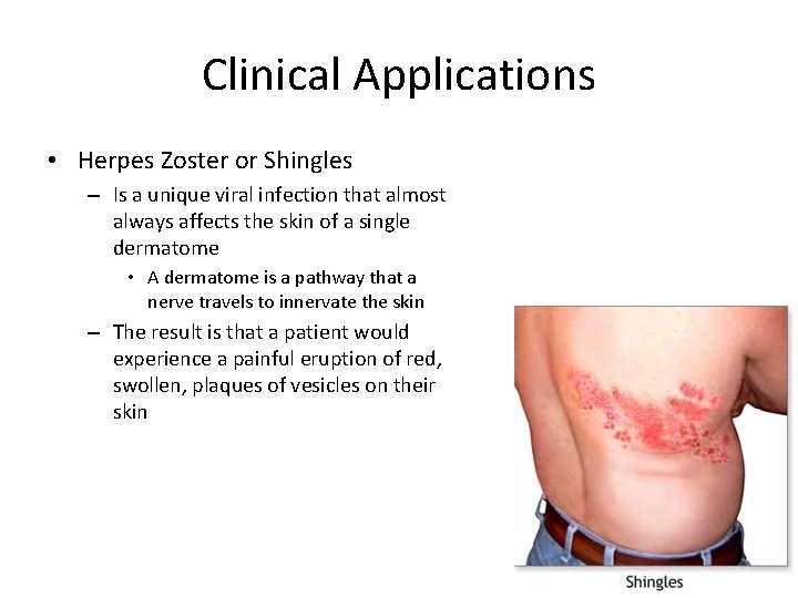 Clinical Applications • Herpes Zoster or Shingles – Is a unique viral infection that