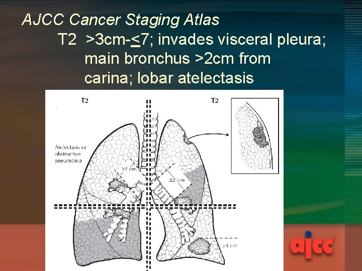 AJCC Cancer Staging Atlas T 2 >3 cm-<7; invades visceral pleura; main bronchus >2