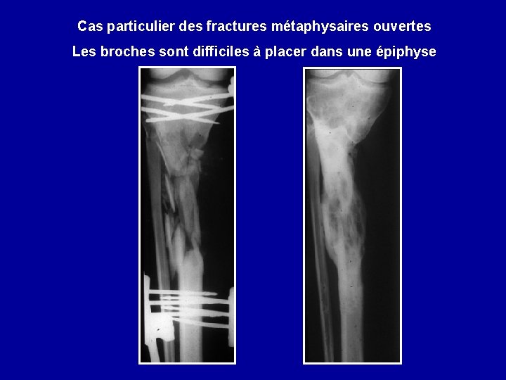 Cas particulier des fractures métaphysaires ouvertes Les broches sont difficiles à placer dans une