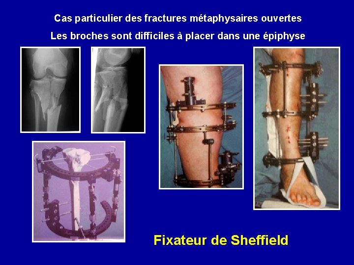 Cas particulier des fractures métaphysaires ouvertes Les broches sont difficiles à placer dans une