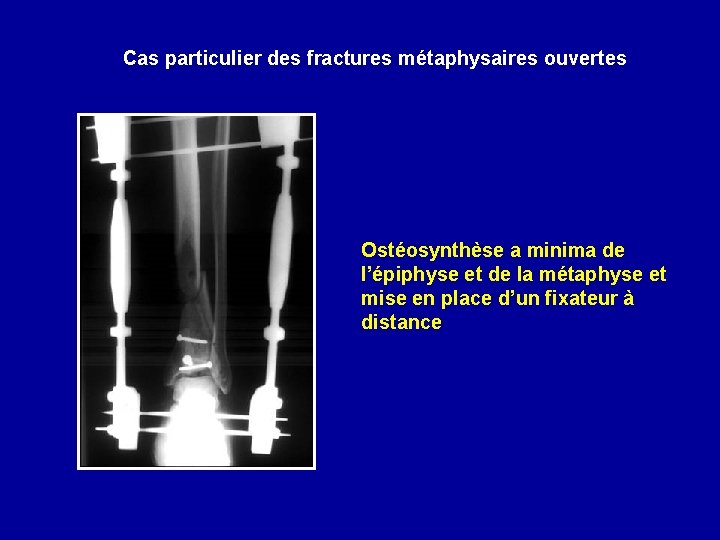 Cas particulier des fractures métaphysaires ouvertes Ostéosynthèse a minima de l’épiphyse et de la