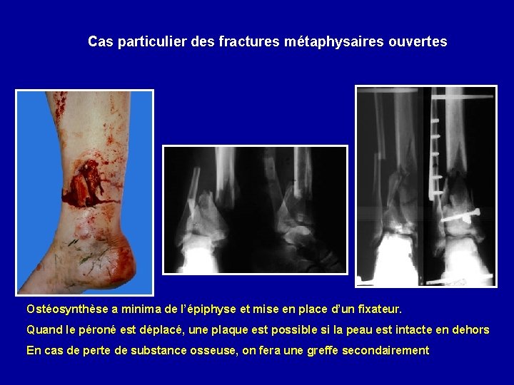 Cas particulier des fractures métaphysaires ouvertes Ostéosynthèse a minima de l’épiphyse et mise en