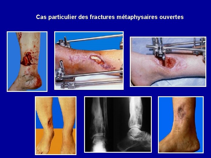 Cas particulier des fractures métaphysaires ouvertes 