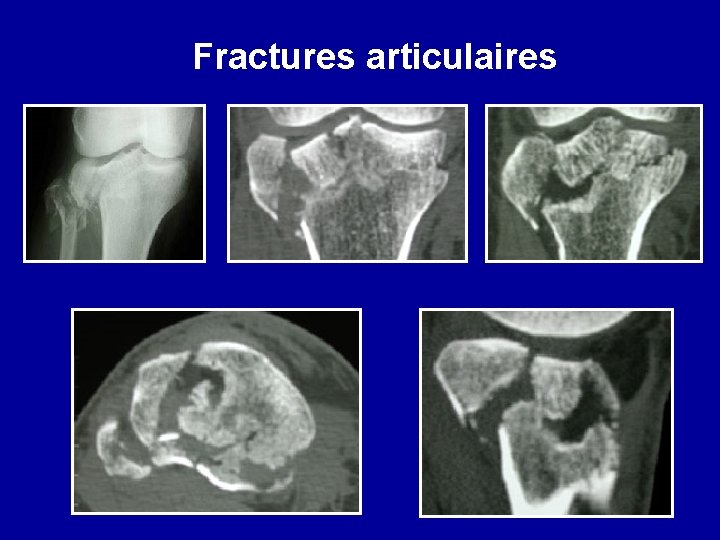 Fractures articulaires 