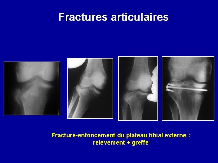 Fractures articulaires Fracture-enfoncement du plateau tibial externe : relèvement + greffe 