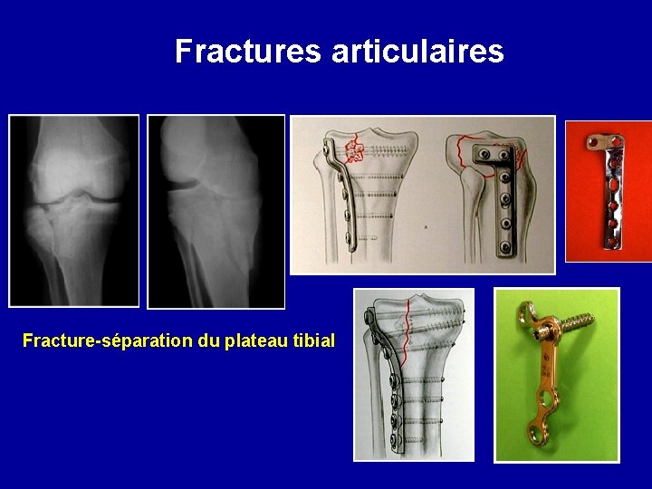 Fractures articulaires Fracture-séparation du plateau tibial 