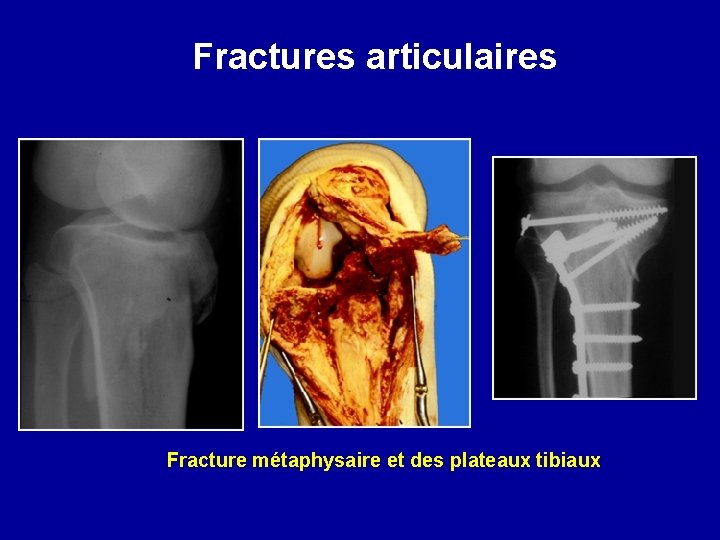 Fractures articulaires Fracture métaphysaire et des plateaux tibiaux 