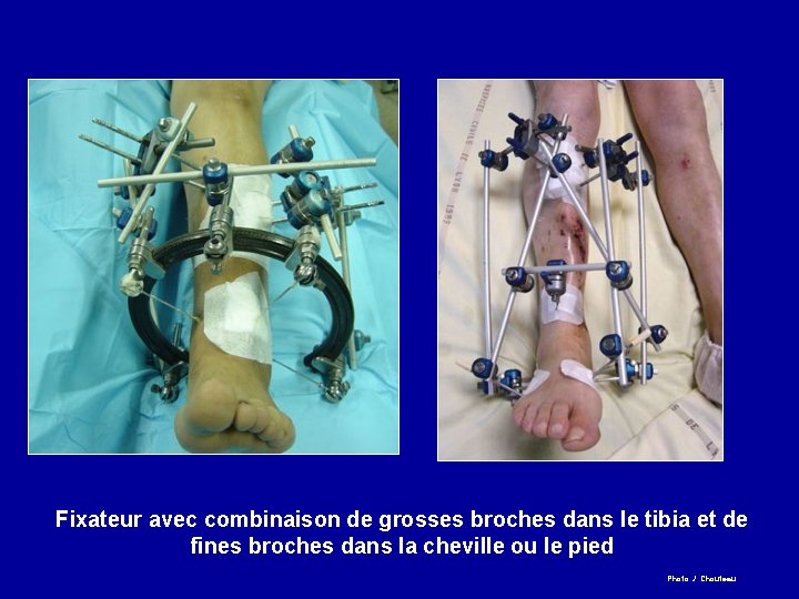 Fixateur avec combinaison de grosses broches dans le tibia et de fines broches dans