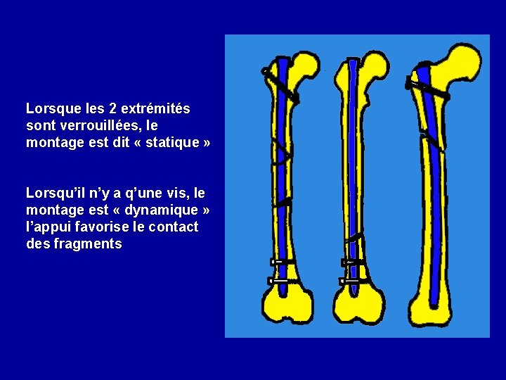 Lorsque les 2 extrémités sont verrouillées, le montage est dit « statique » Lorsqu’il