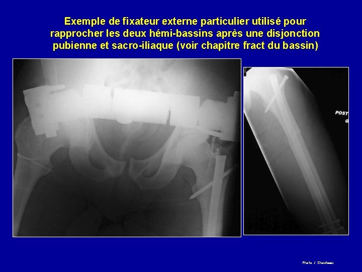 Exemple de fixateur externe particulier utilisé pour rapprocher les deux hémi-bassins après une disjonction