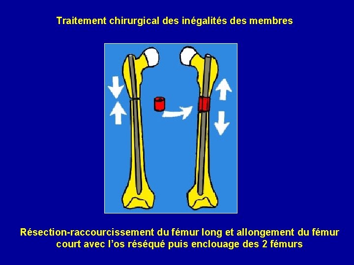 Traitement chirurgical des inégalités des membres Résection-raccourcissement du fémur long et allongement du fémur