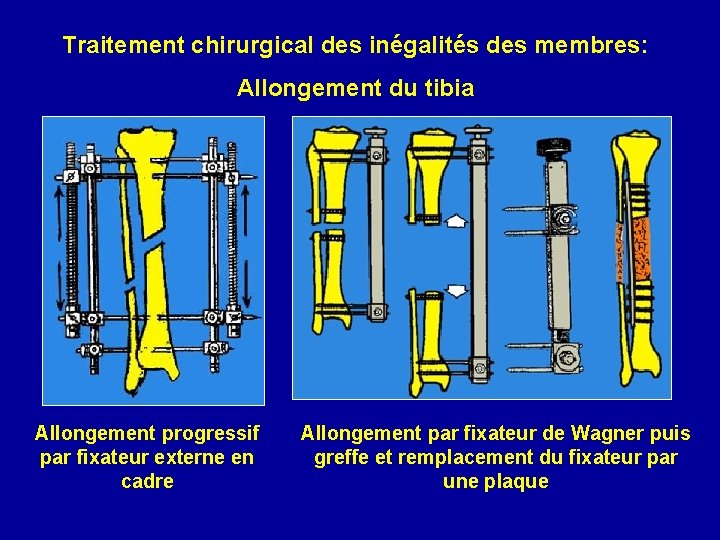 Traitement chirurgical des inégalités des membres: Allongement du tibia Allongement progressif par fixateur externe