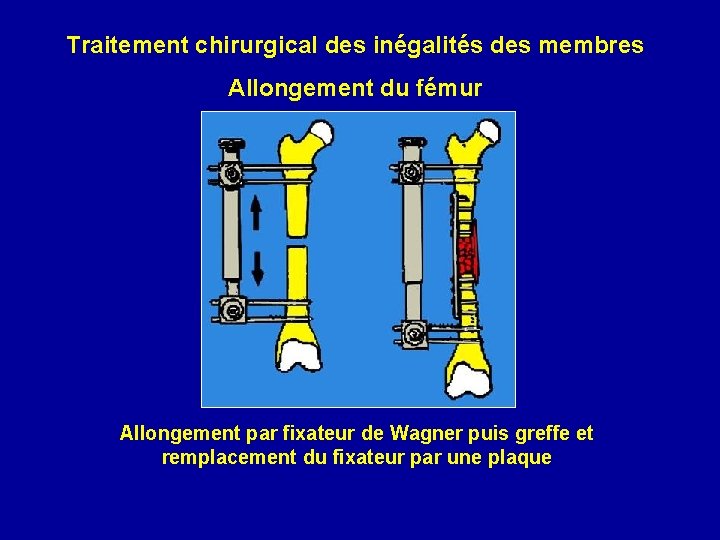 Traitement chirurgical des inégalités des membres Allongement du fémur Allongement par fixateur de Wagner