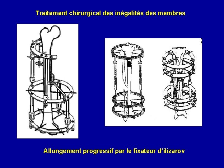 Traitement chirurgical des inégalités des membres Allongement progressif par le fixateur d’ilizarov 