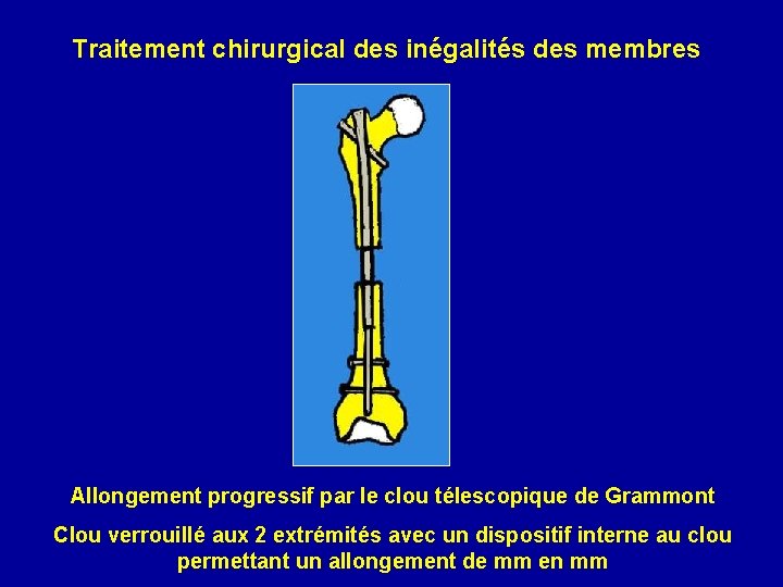 Traitement chirurgical des inégalités des membres Allongement progressif par le clou télescopique de Grammont