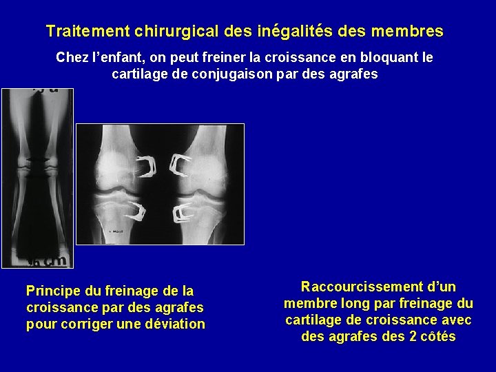 Traitement chirurgical des inégalités des membres Chez l’enfant, on peut freiner la croissance en