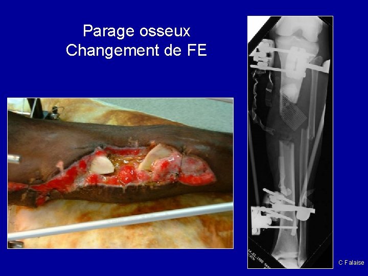 Parage osseux Changement de FE C Falaise 