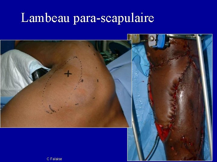 Lambeau para-scapulaire C Falaise 