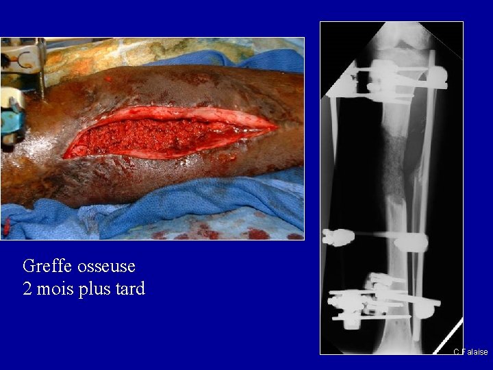 Greffe osseuse 2 mois plus tard C Falaise 