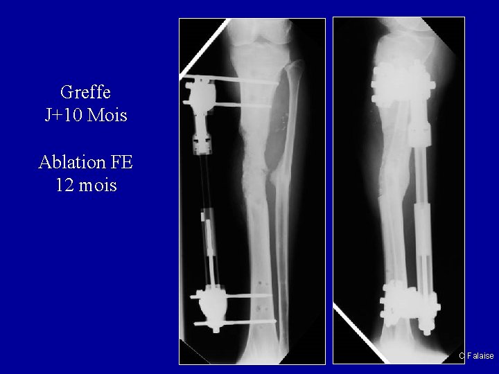 Greffe J+10 Mois Ablation FE 12 mois C Falaise 