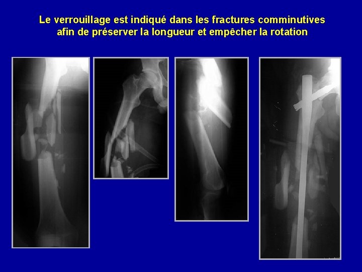 Le verrouillage est indiqué dans les fractures comminutives afin de préserver la longueur et