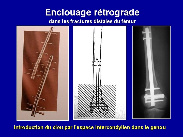 Enclouage rétrograde dans les fractures distales du fémur Introduction du clou par l’espace intercondylien