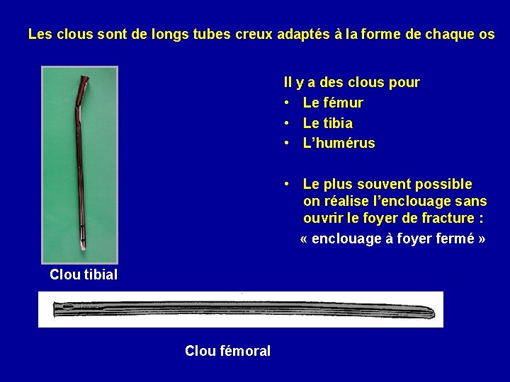 Les clous sont de longs tubes creux adaptés à la forme de chaque os