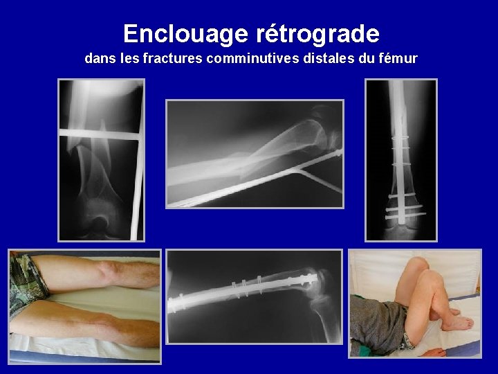 Enclouage rétrograde dans les fractures comminutives distales du fémur 