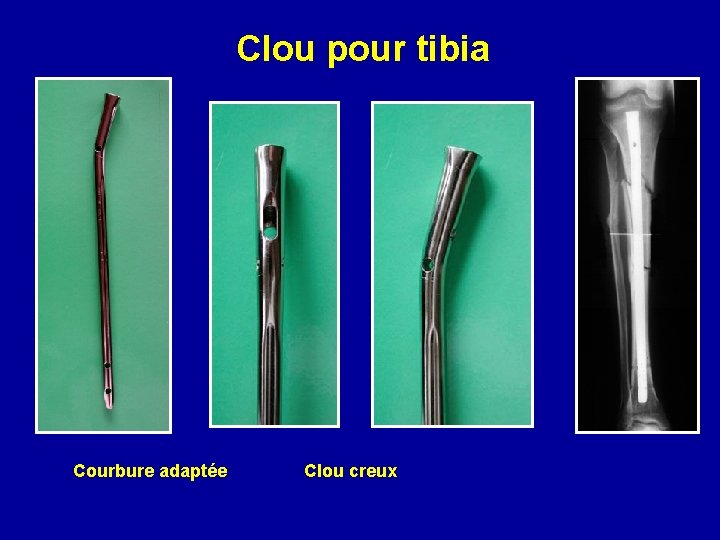 Clou pour tibia Courbure adaptée Clou creux 