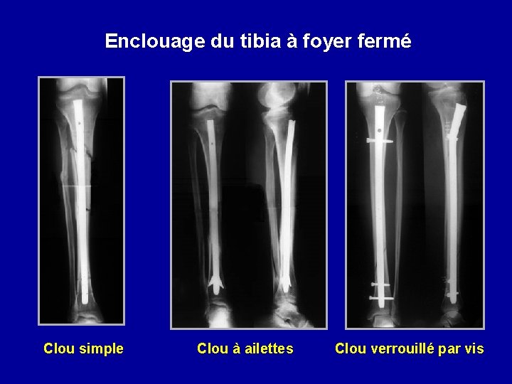 Enclouage du tibia à foyer fermé Clou simple Clou à ailettes Clou verrouillé par