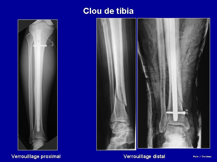 Clou de tibia Verrouillage proximal Verrouillage distal Photo J. Chouteau 