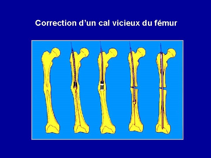 Correction d’un cal vicieux du fémur 