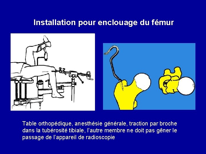 Installation pour enclouage du fémur Table orthopédique, anesthésie générale, traction par broche dans la