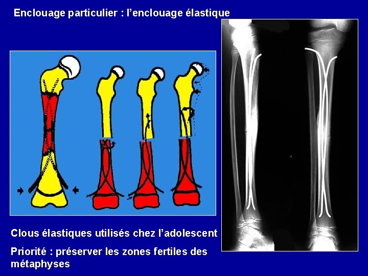 Enclouage particulier : l’enclouage élastique Clous élastiques utilisés chez l’adolescent Priorité : préserver les