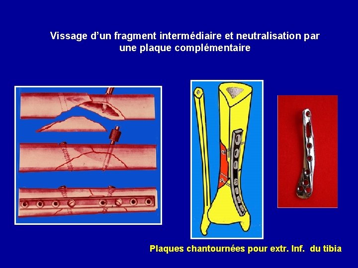 Vissage d’un fragment intermédiaire et neutralisation par une plaque complémentaire Plaques chantournées pour extr.