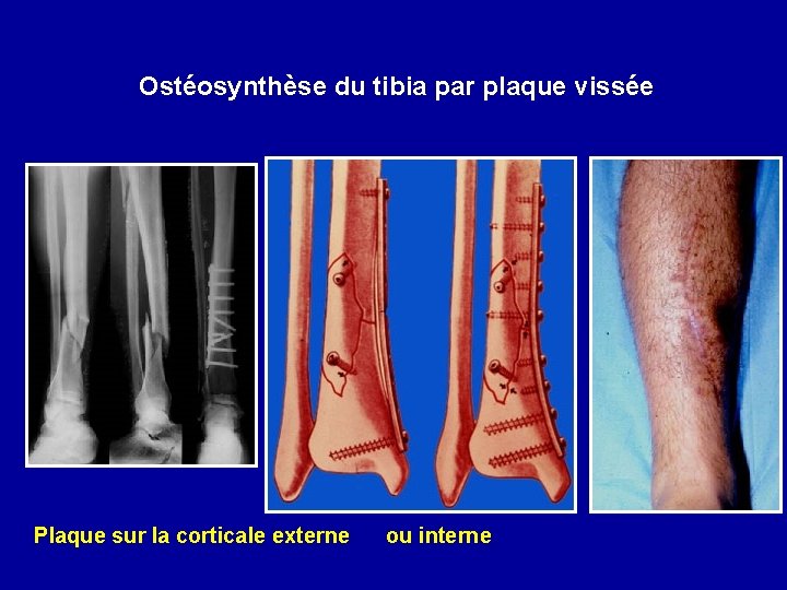 Ostéosynthèse du tibia par plaque vissée Plaque sur la corticale externe ou interne 