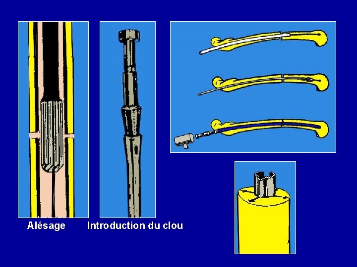 Alésage Introduction du clou 