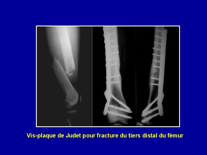 Vis-plaque de Judet pour fracture du tiers distal du fémur 