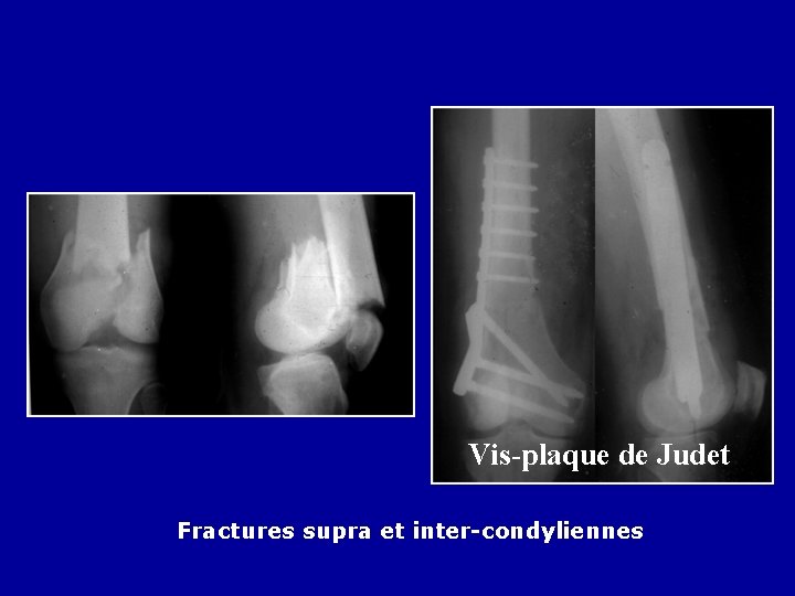 Vis-plaque de Judet Fractures supra et inter-condyliennes 