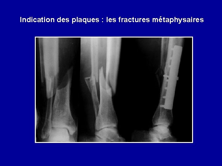 Indication des plaques : les fractures métaphysaires 