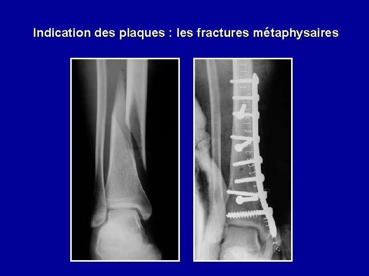 Indication des plaques : les fractures métaphysaires 