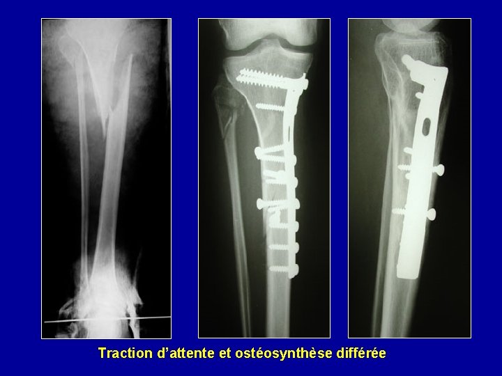 Traction d’attente et ostéosynthèse différée 