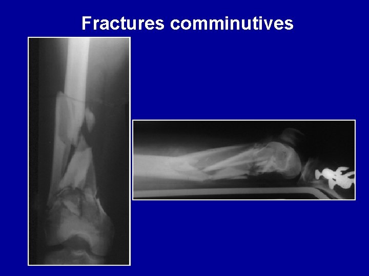 Fractures comminutives 