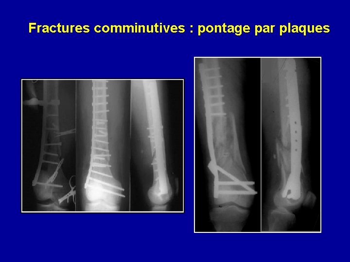 Fractures comminutives : pontage par plaques 