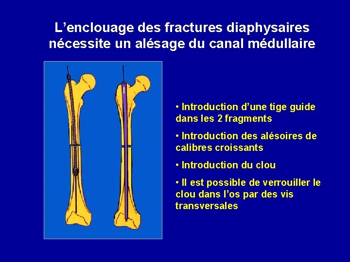 L’enclouage des fractures diaphysaires nécessite un alésage du canal médullaire • Introduction d’une tige