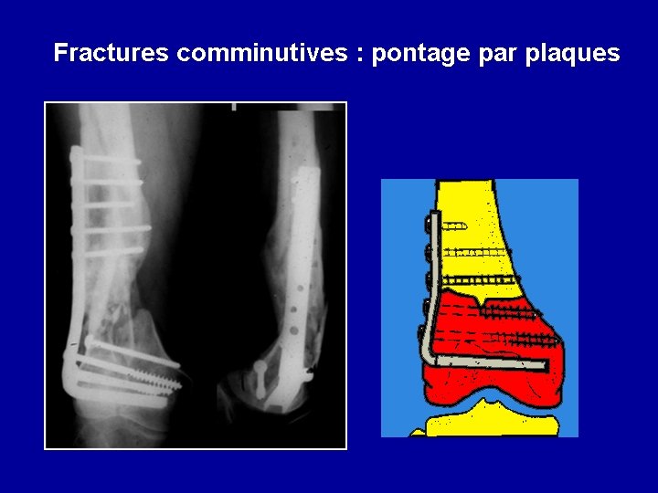 Fractures comminutives : pontage par plaques 