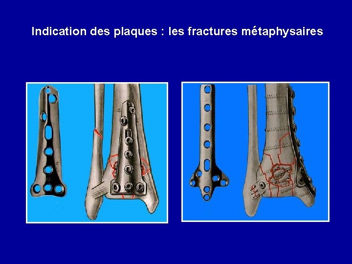 Indication des plaques : les fractures métaphysaires 