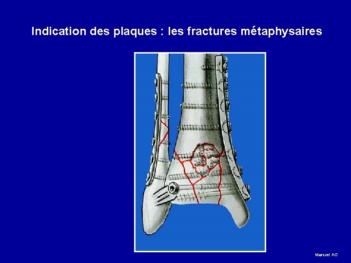 Indication des plaques : les fractures métaphysaires Manuel AO 