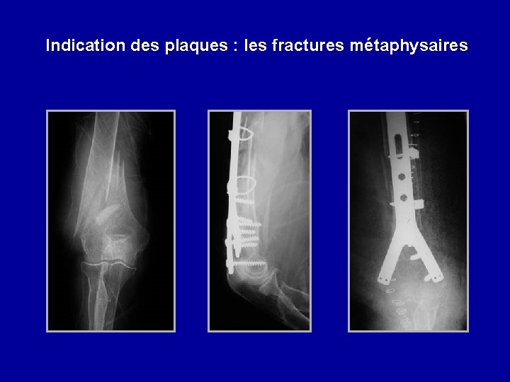 Indication des plaques : les fractures métaphysaires 